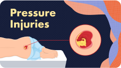 Wound Series Resource 4 - Pressure Injuries